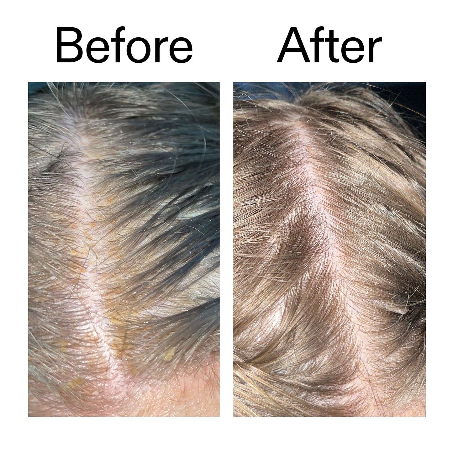 salicylic-acid-exfoliating-scalp-treatment-i8 Salicylic_Acid_Exfoliating_Scalp_Treatment_Before_After_2000x2000_e572a30f-057c-4a48-823b-1c09dc97f8d0.jpg
