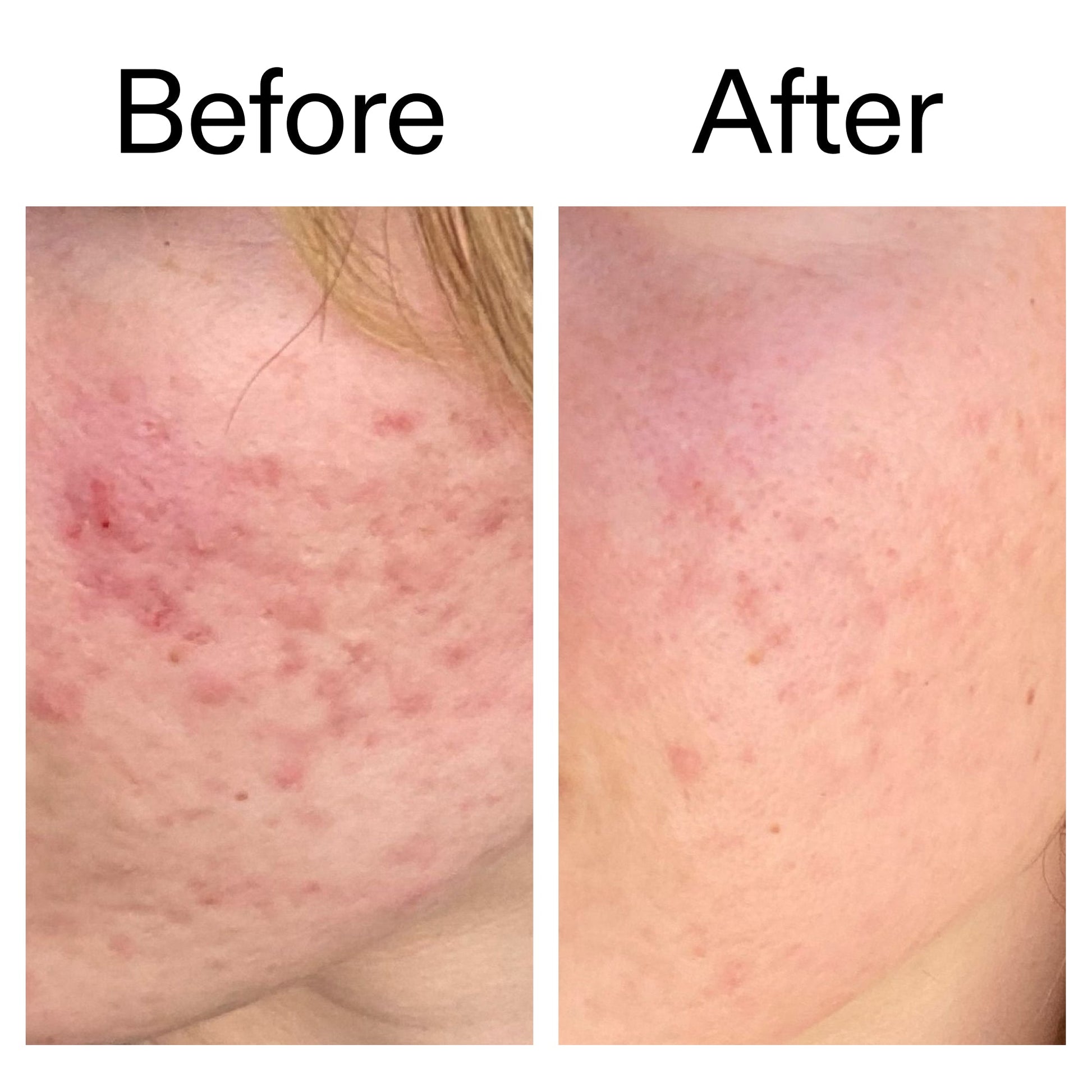 10-azelaic-acid-serum-for-redness-relief-x3 Azealic_Acid_Serum_B_A_Ppage_2000_x_2000.jpg