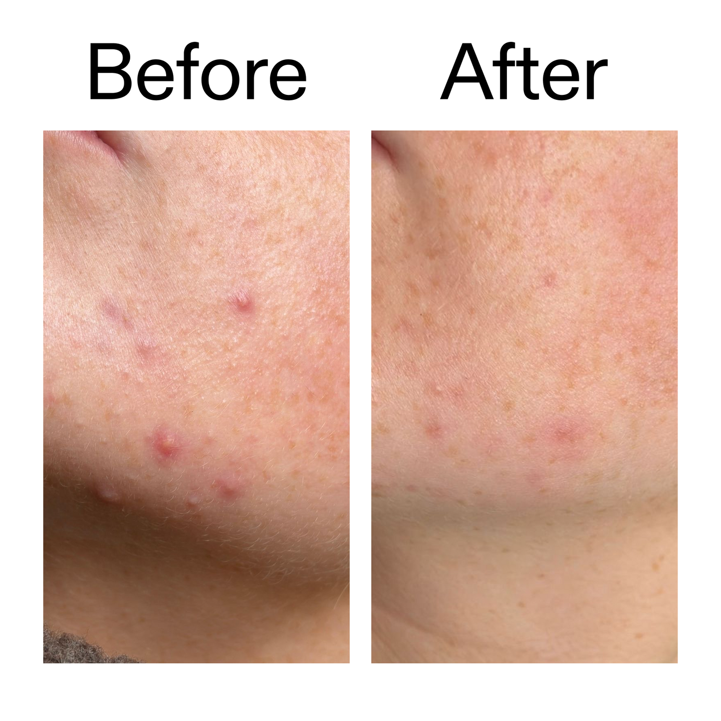10-azelaic-acid-serum-for-redness-relief-x3 B_A_1_PPAGE.png