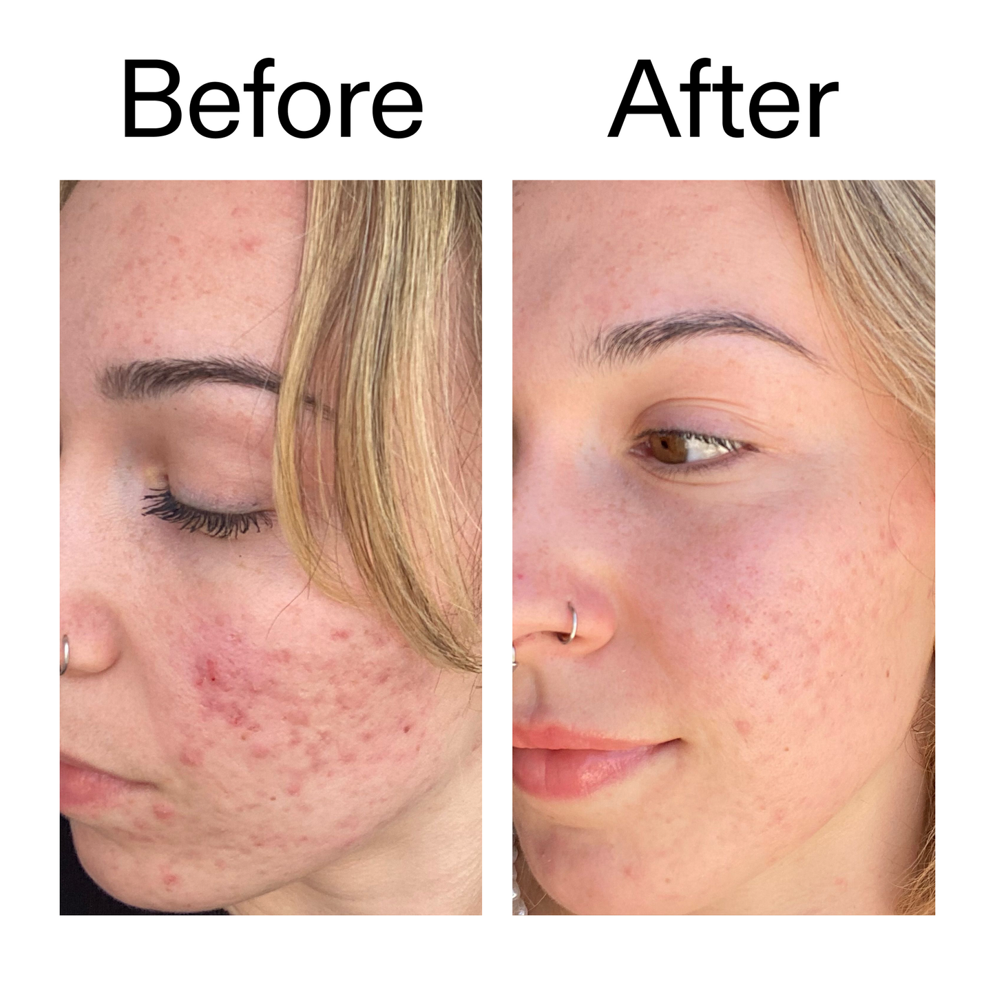 10-azelaic-acid-serum-for-redness-relief-x3 B_A_2_PPAGE.png