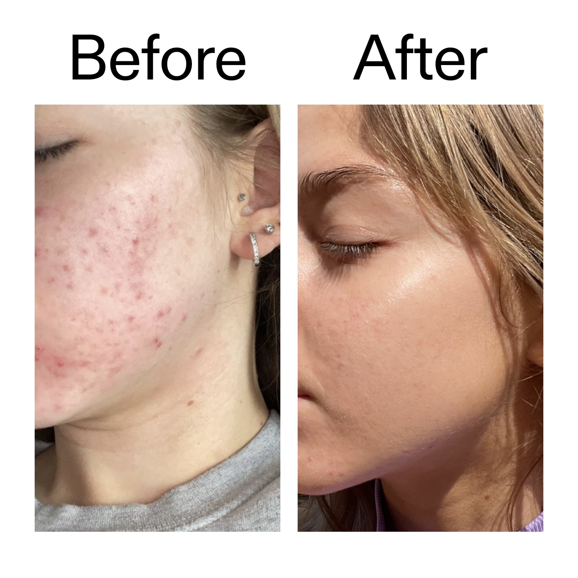 beta-hydroxy-acid-bha-serum-m8 Beta_Hydroxy_Acid_Serum_Before_After_2000x2000_96fda3e5-938d-49ef-bcf2-a0fa6ece4e2c.jpg