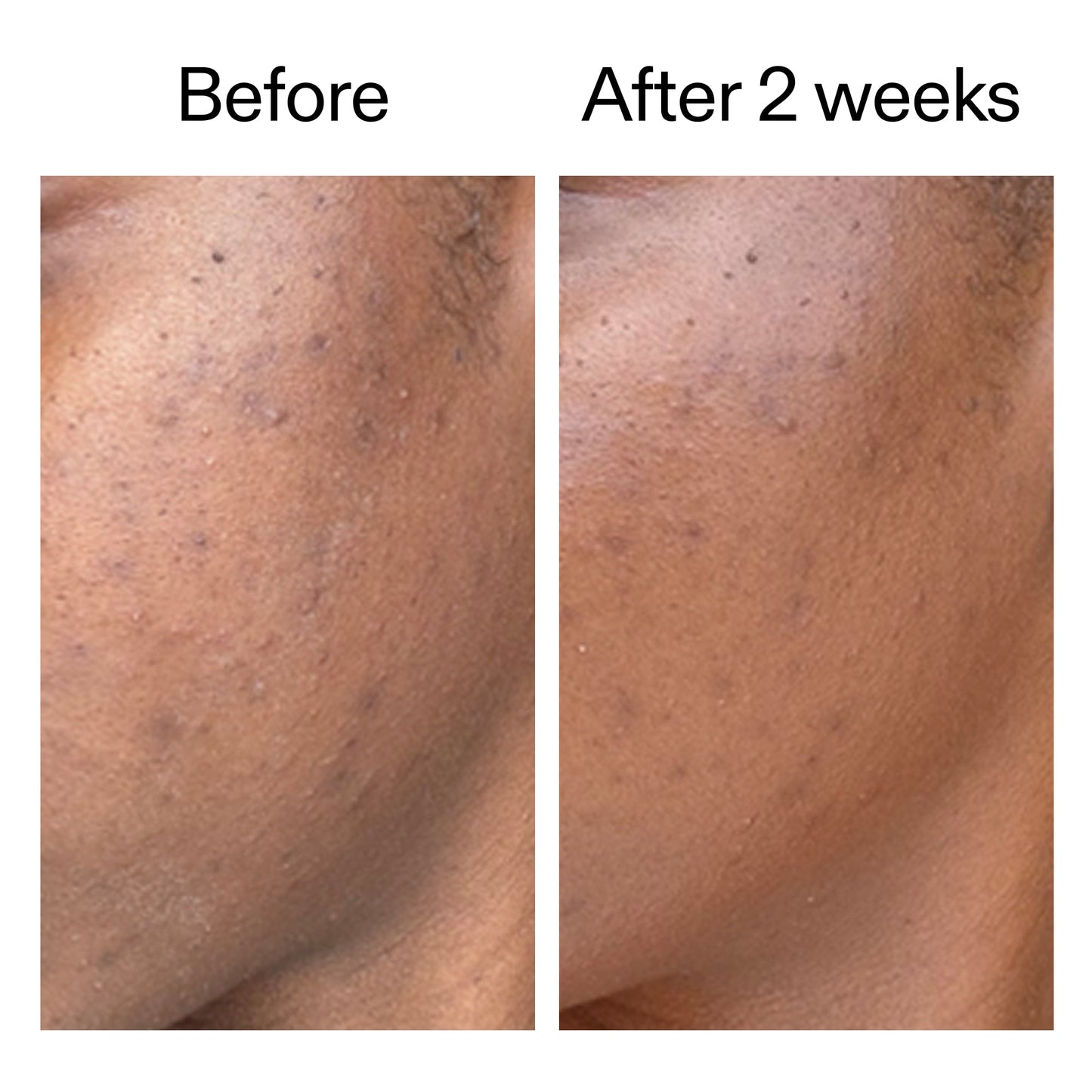 360-acne-clearing-serum-z2 DIOICB_A2000x2000.jpg