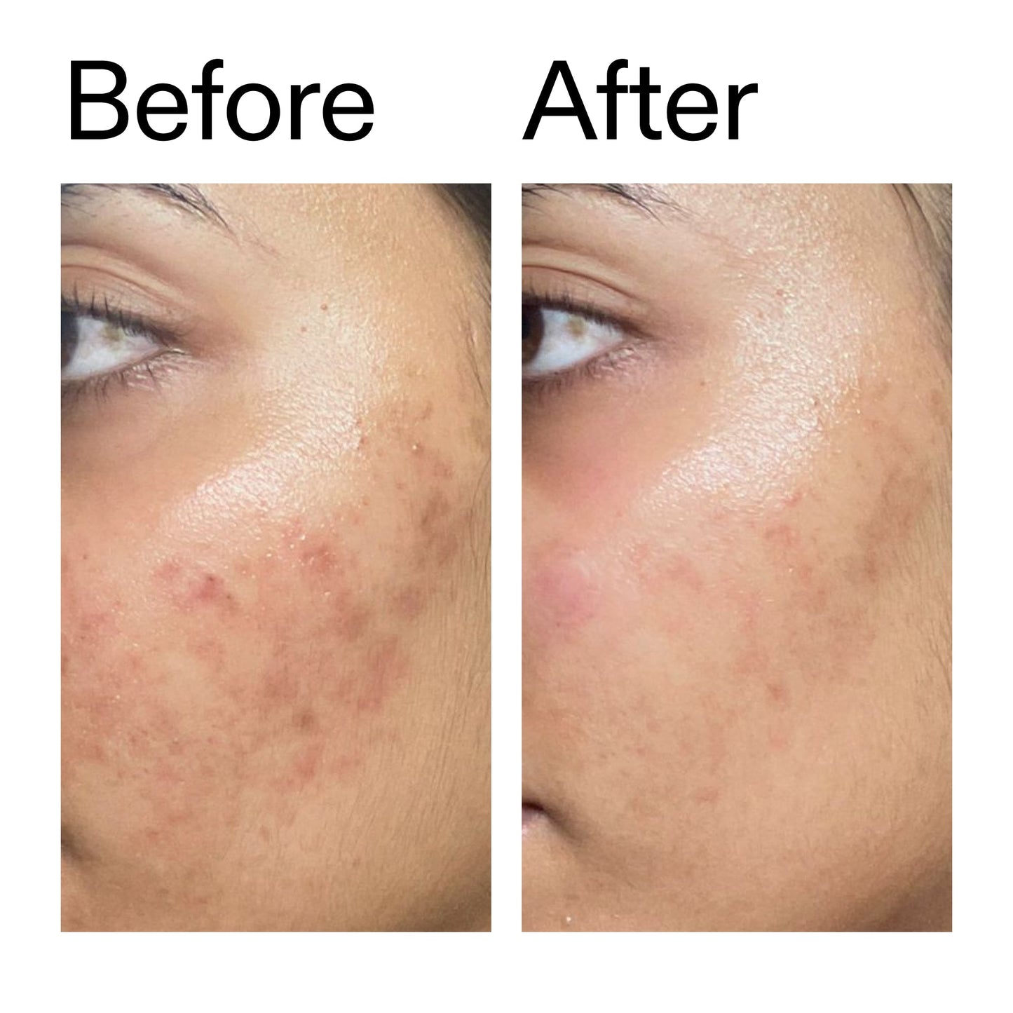 ectoin-hydro-barrier-serum-h3 Ectoin_Hydro-barrier_Serum__Before_After_2000x2000_34261920-d004-48d0-9c7b-8e1c15971bfd.jpg