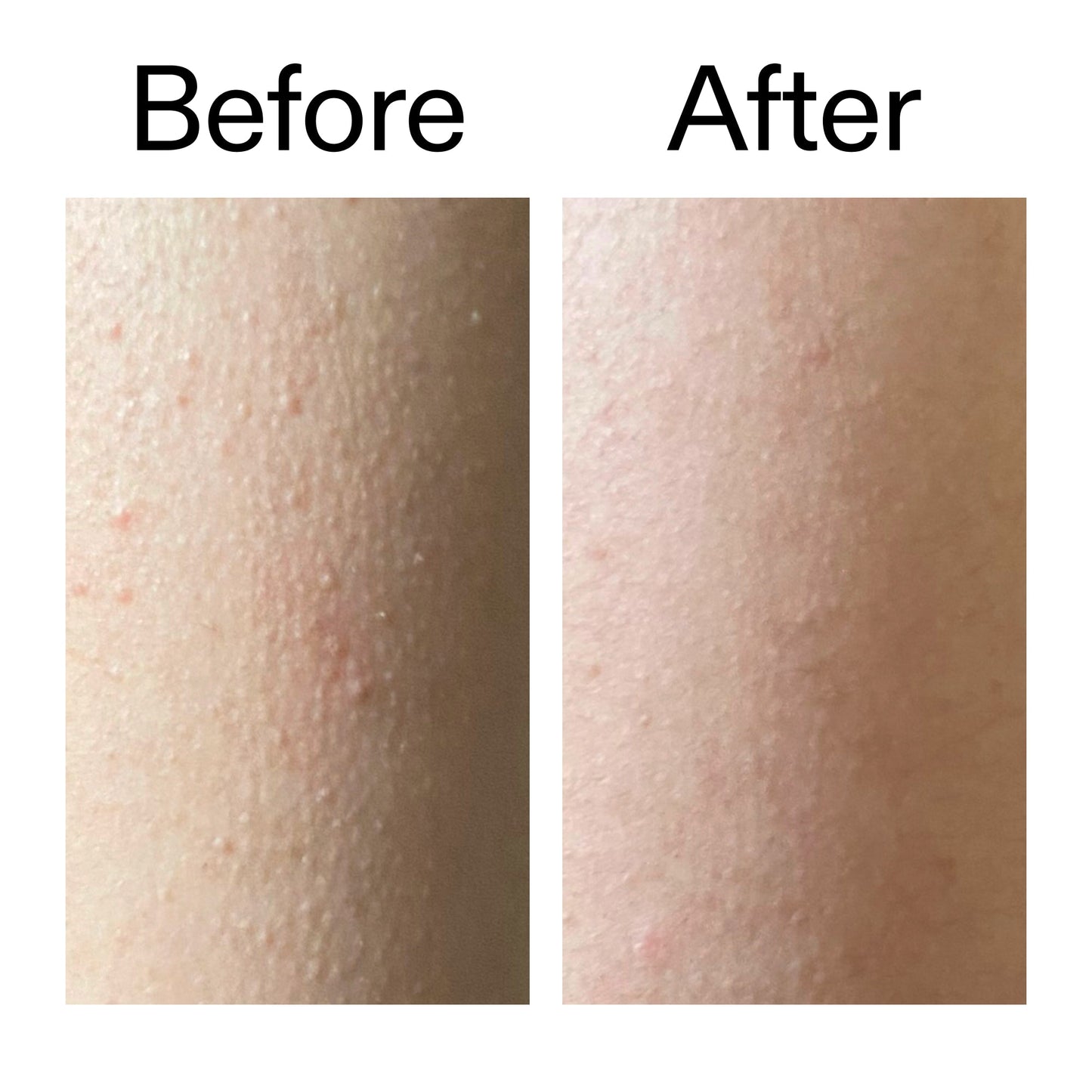 glycolic-acid-exfoliating-body-stick-x5 Glycolic_Acid_Exfoliating_Body_Stick_Before_After_V2_2000x2000_2e4ba052-94f6-4d56-82df-7bdb5b2df7ae.jpg