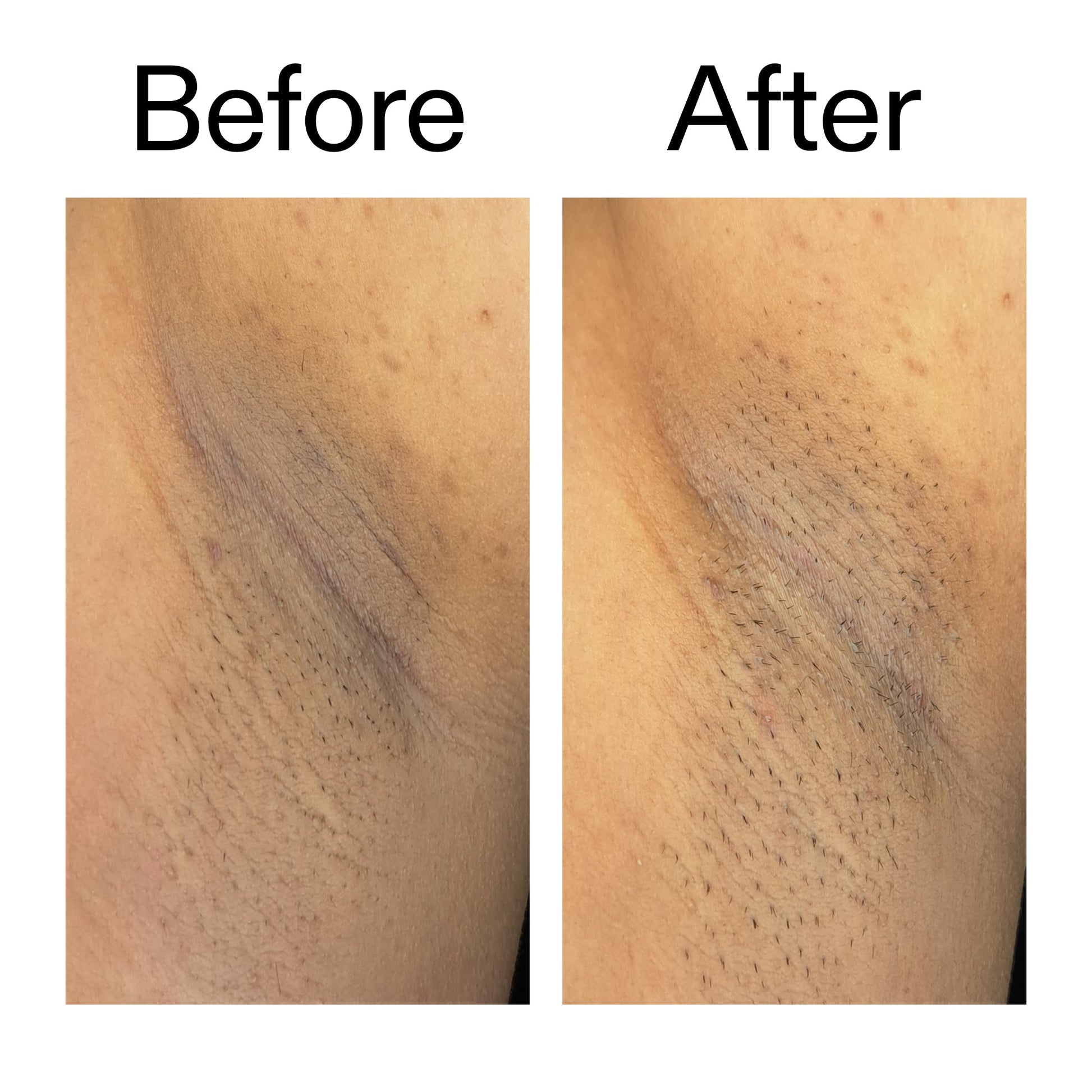 glycolic-acid-exfoliating-body-stick-x5 Glycolic_Acid_Exfoliating_Body_Stick_Before_After_V3_2000x2000_ea919cd9-1439-4a46-82a0-76200eb5bb42.jpg