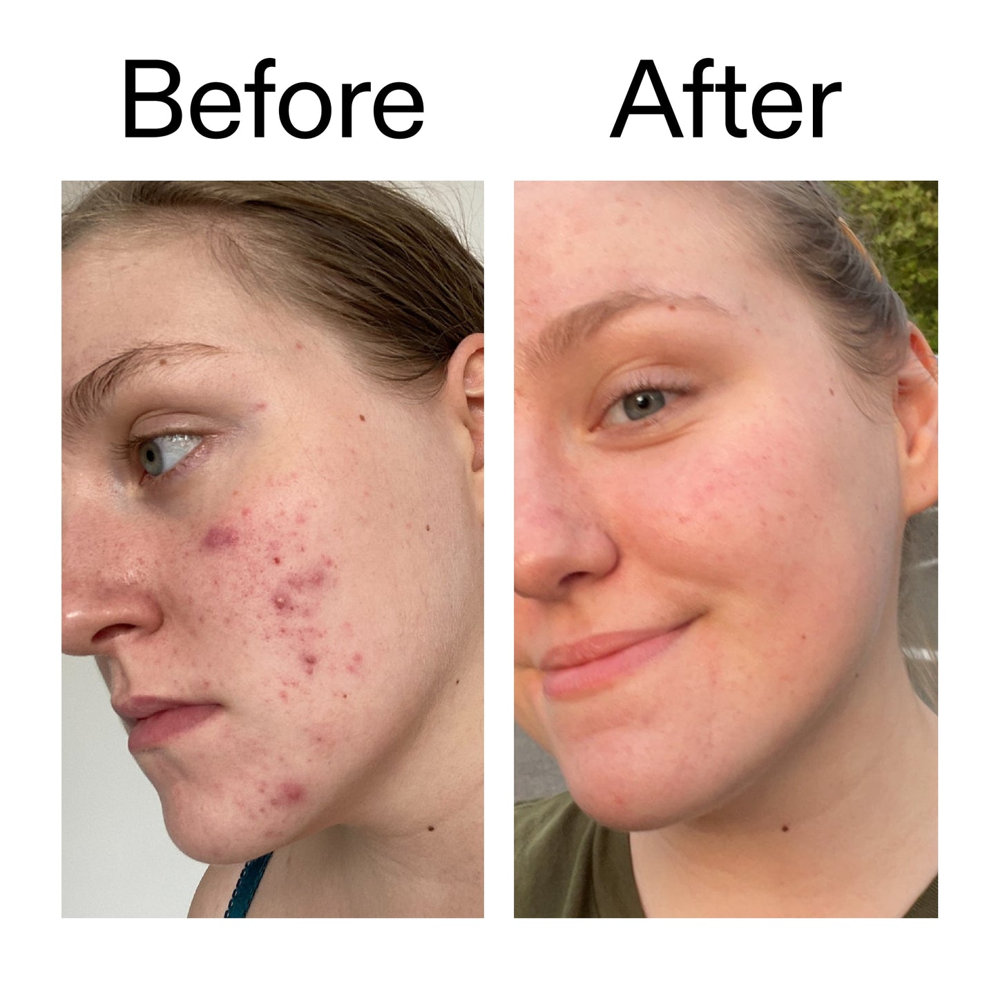 glycolic-acid-toner-h0 Glycolic_Acid_Toner_Before_After_2000x2000_49f0b9f7-e71b-4b2e-a8f8-2ea4b73247bb.jpg