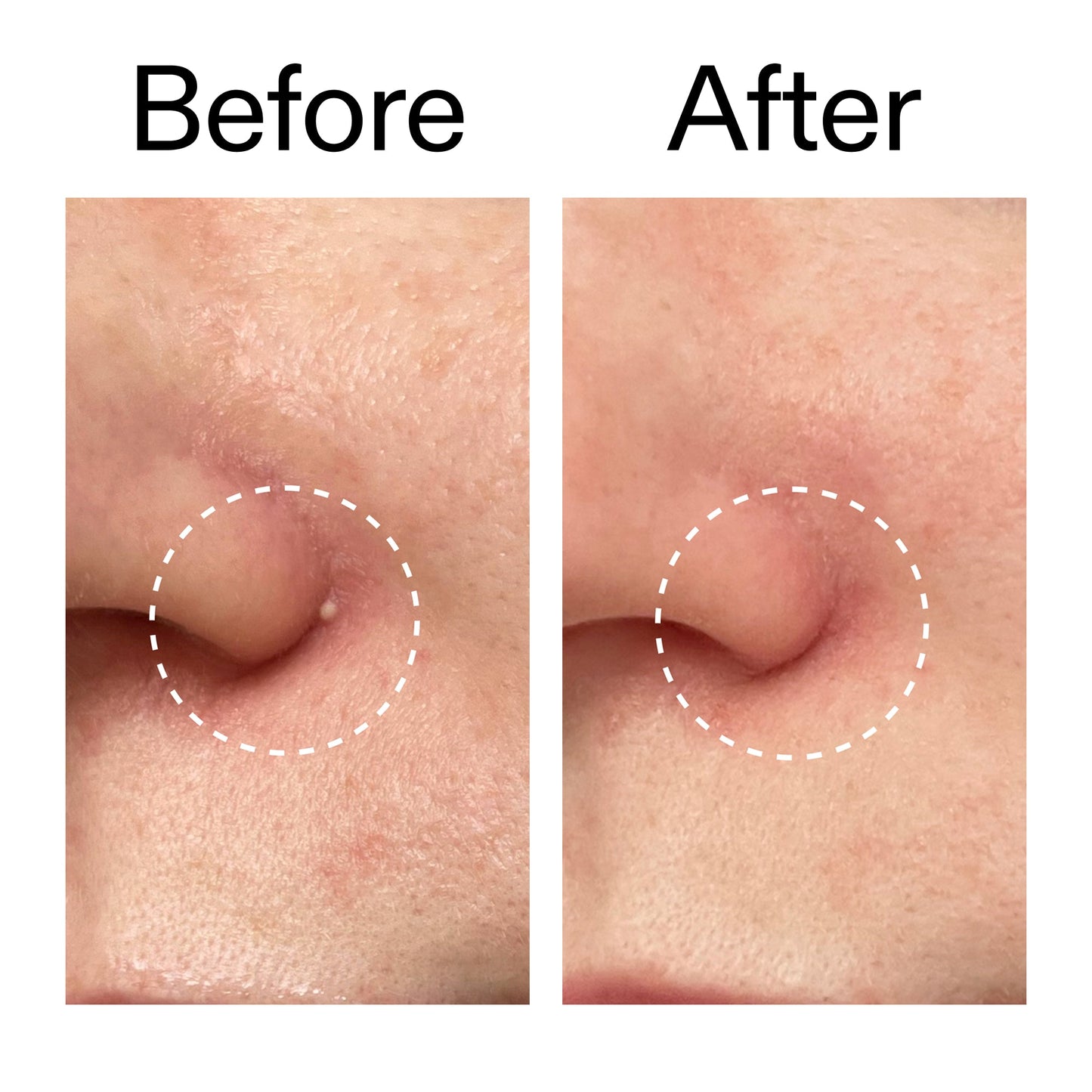 hydrocolloid-invisible-pimple-patches-pack-of-22-i2 Hydrocolloid_Invisible_Pimple_Patches_Before_After_2000x2000_b02aa37b-c78a-4682-91de-9135af5bb7df.jpg