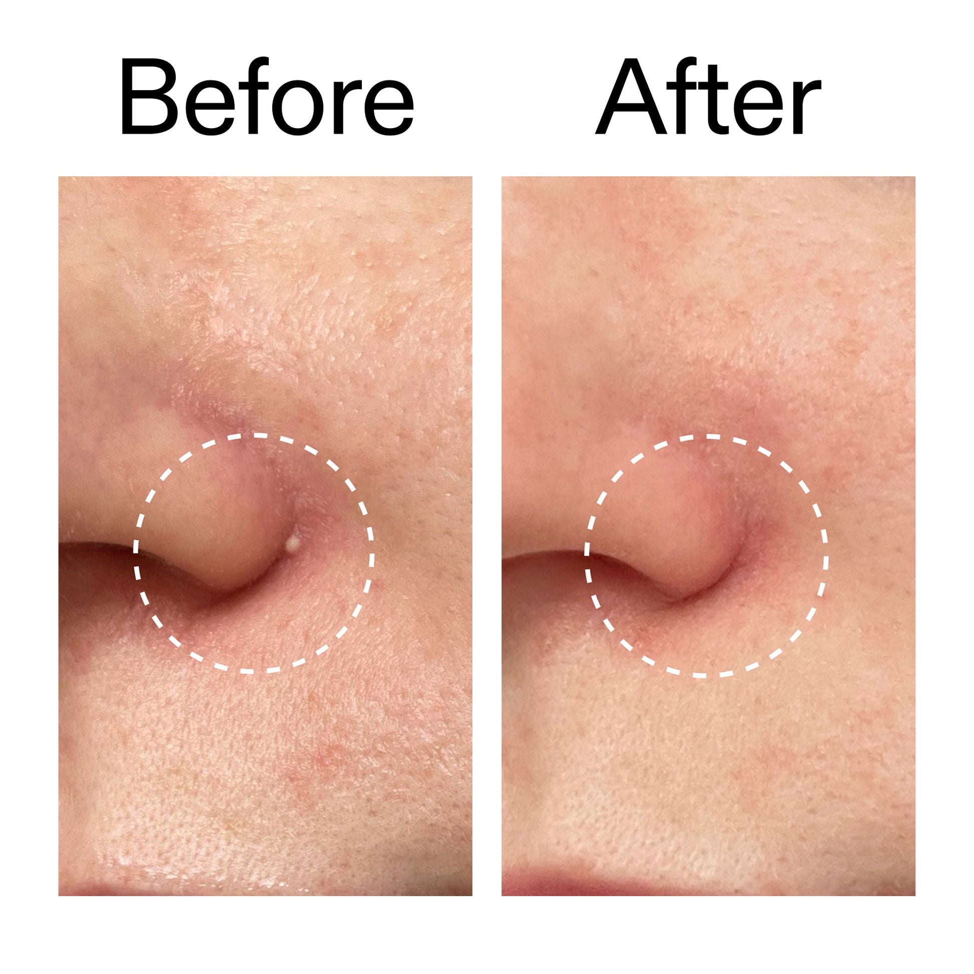 hydrocolloid-invisible-pimple-patches-pack-of-22-i2 Hydrocolloid_Invisible_Pimple_Patches_Before_After_2000x2000_b02aa37b-c78a-4682-91de-9135af5bb7df.jpg