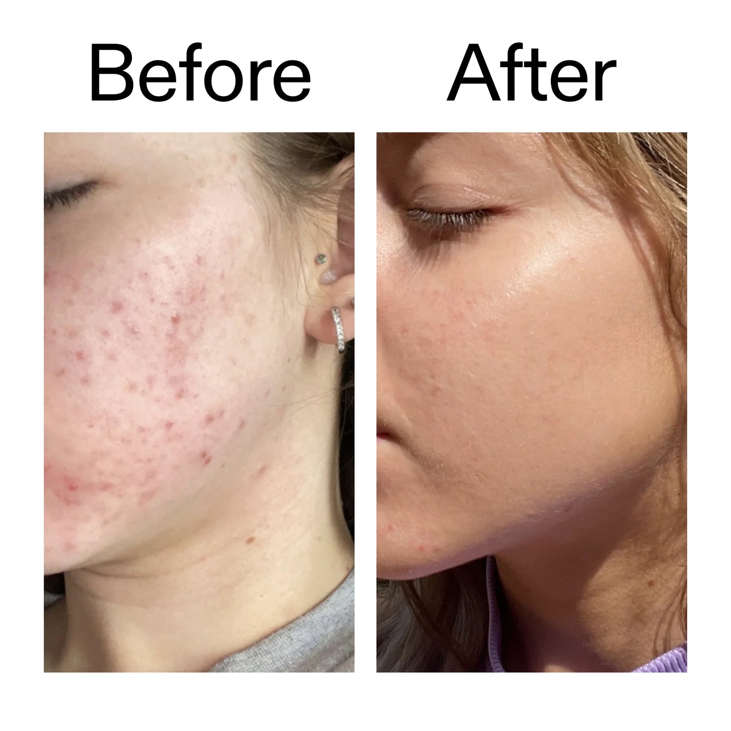 10-niacinamide-serum-u5 Niacinamide_Serum_Before_After_2000x2000_bde32455-9e7d-448e-b053-bef41504f0a9.jpg
