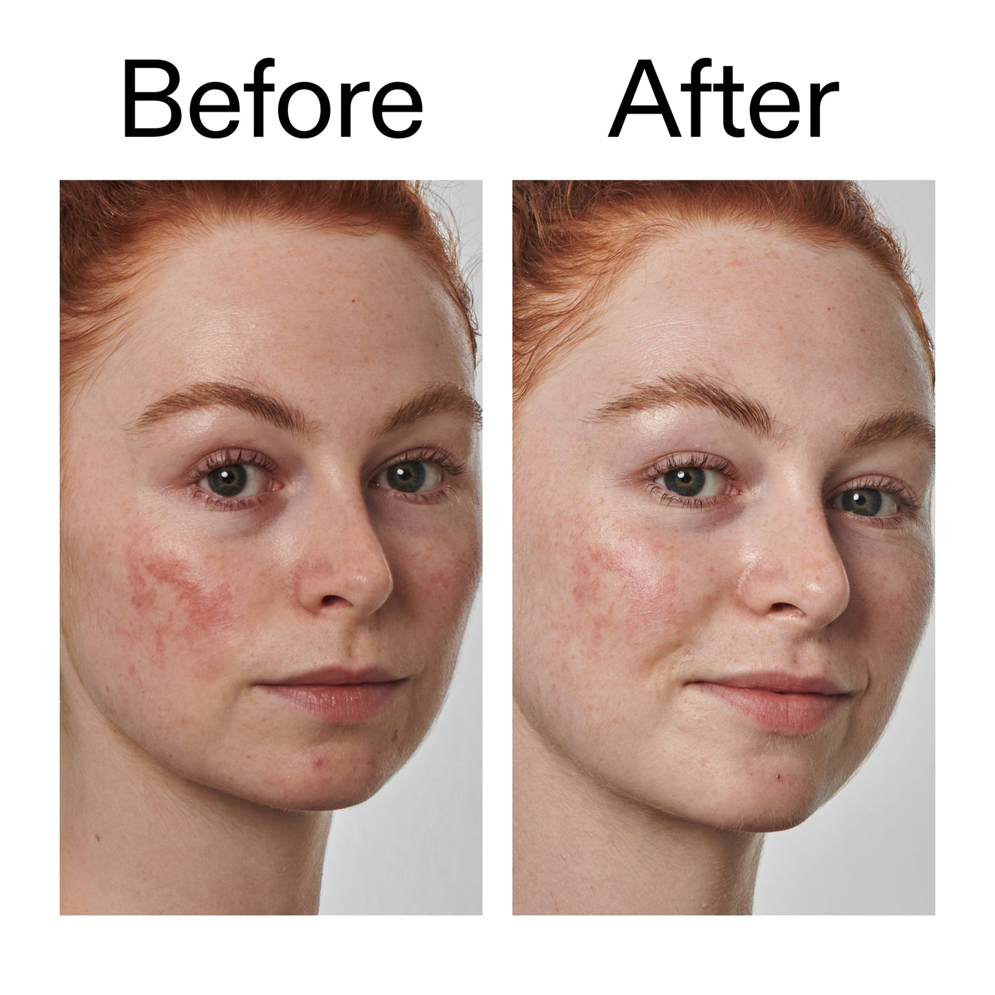 10-azelaic-acid-serum-for-redness-relief-x3 Redness_Relief_Serum_Before_After_2000x2000_3334dc9a-cce9-4e00-8aec-7ad89ca051f2.jpg