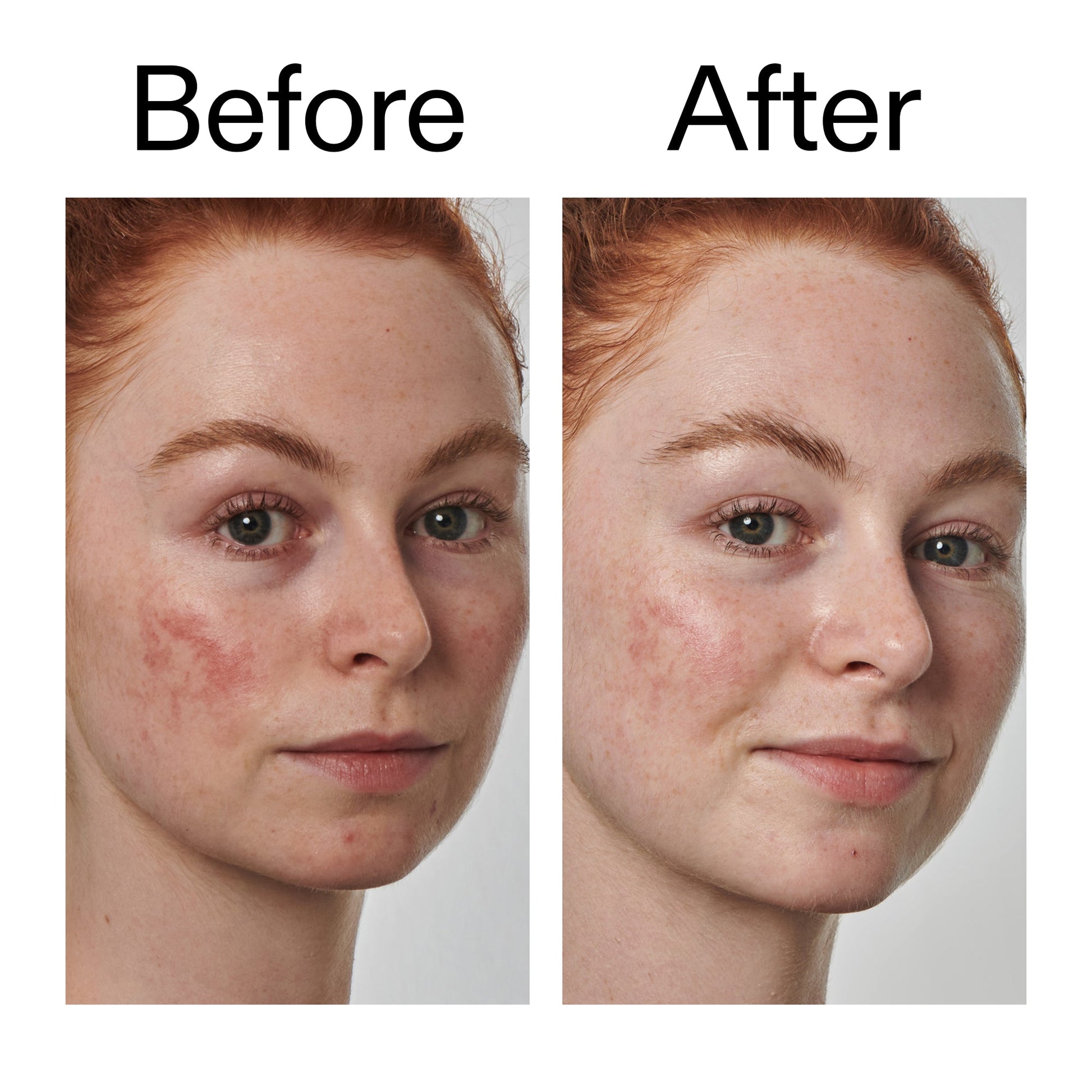 10-azelaic-acid-serum-for-redness-relief-x3 Redness_Relief_Serum_Before_After_2000x2000_3334dc9a-cce9-4e00-8aec-7ad89ca051f2.jpg