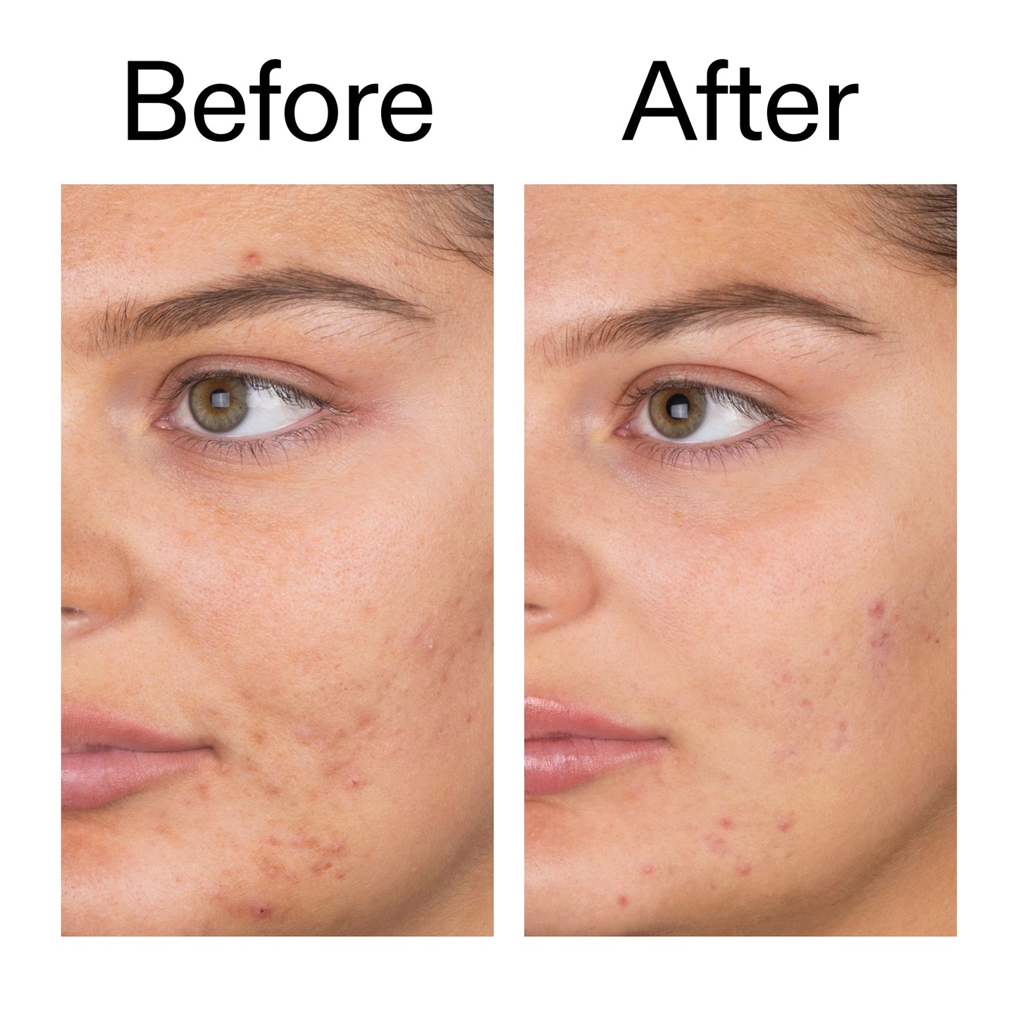 salicylic-acid-cleanser-duo-k5 Salicylic_Acid_Cleanser_-_150ml_Before_After_2000x2000_e7230494-853f-4b07-82b1-27669104c995.jpg