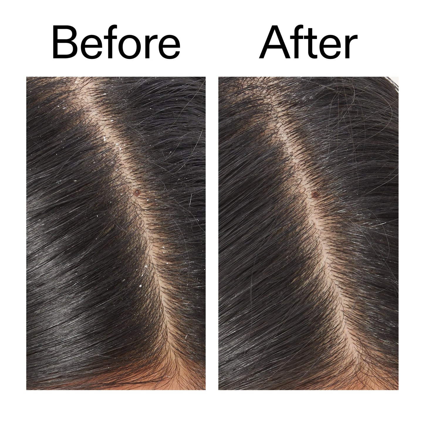 salicylic-acid-exfoliating-scalp-treatment-i8 Salicylic_Acid_Exfoliating_Scalp_Treatment_Before_After_V2_2000x2000_02bd61ad-42bf-490b-b3e3-7e04b2e8a673.jpg