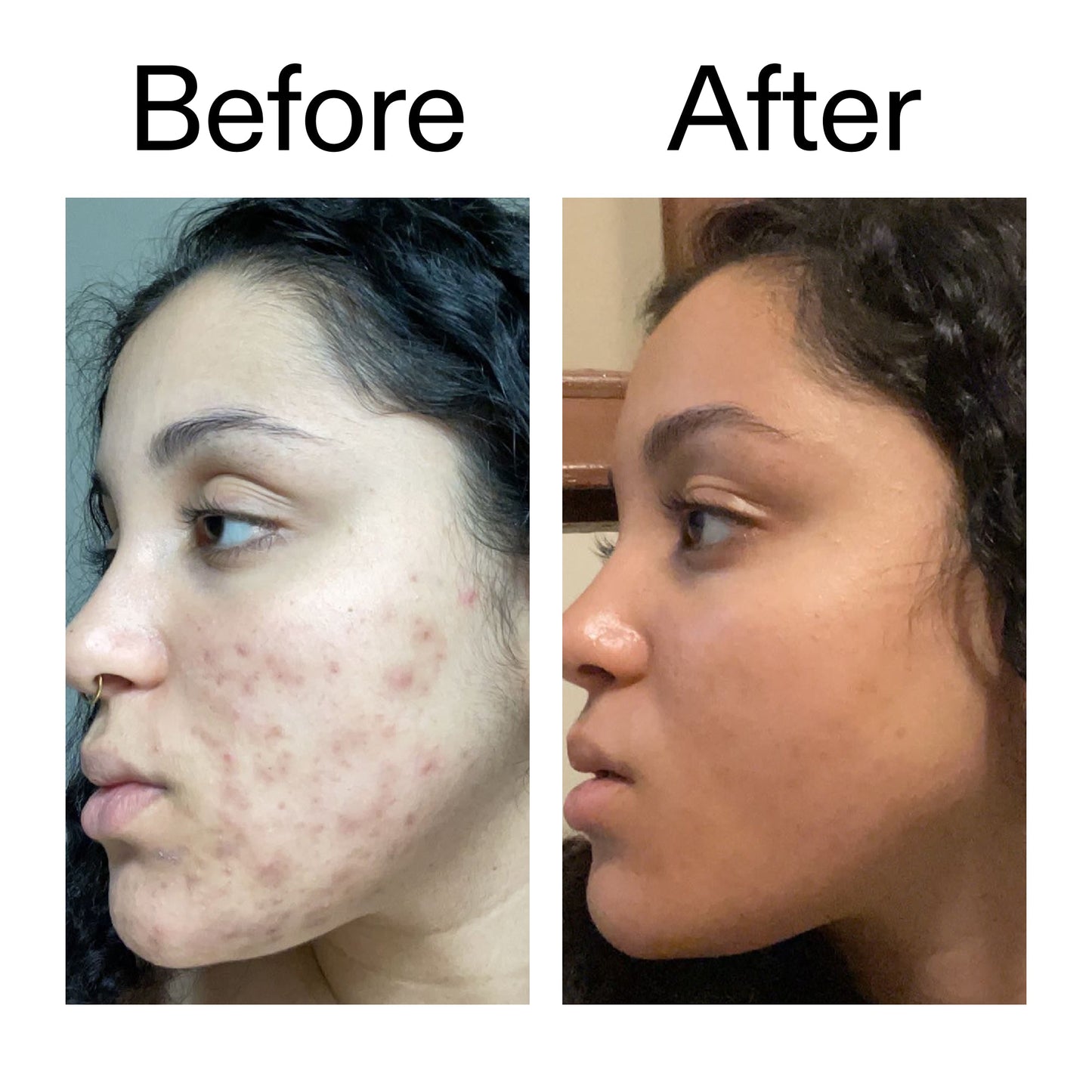 tranexamic-acid-serum-l4 Tranexamic_Acid_Serum_Before_After_2000x2000_98ebc8be-77b0-4843-8a22-90790ebe918b.jpg